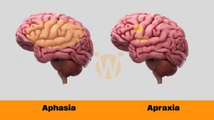 Decoding the Differences: Aphasia and Apraxia Unveiled
